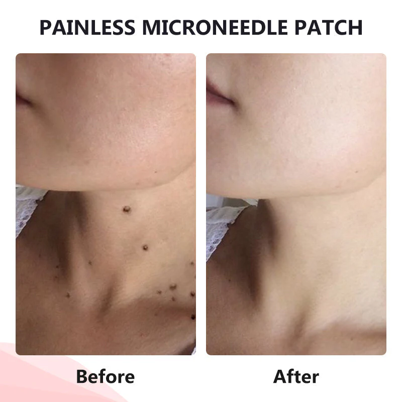 Painless Micro-patch