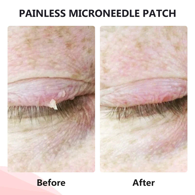 Painless Micro-patch