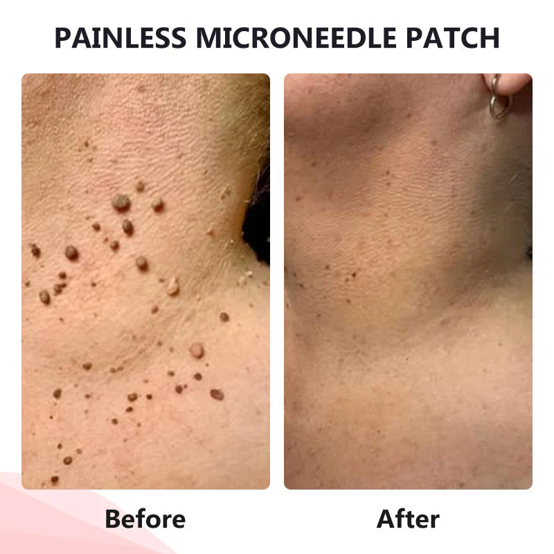 Painless Micro-patch