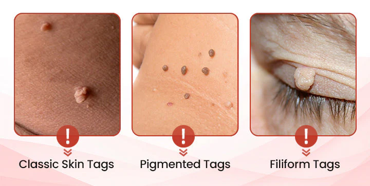 Painless Micro-patch