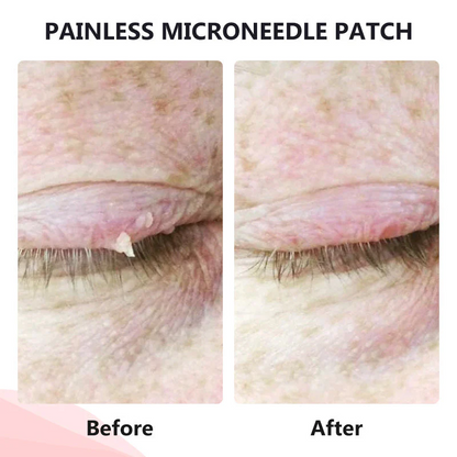 Painless Micro-patch